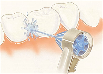 Cómo funciona un irrigador bucal