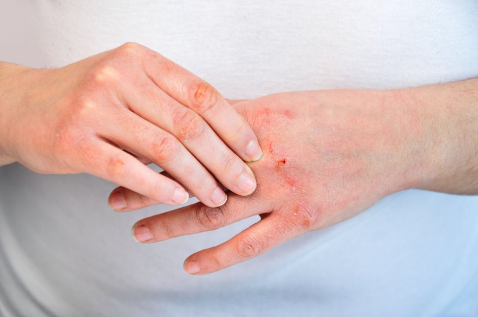 Cómo aliviar el picor en la dermatitis atópica