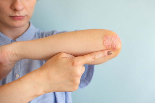 Psoriasis descamacion piel